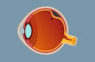 O que é descolamento de Retina?