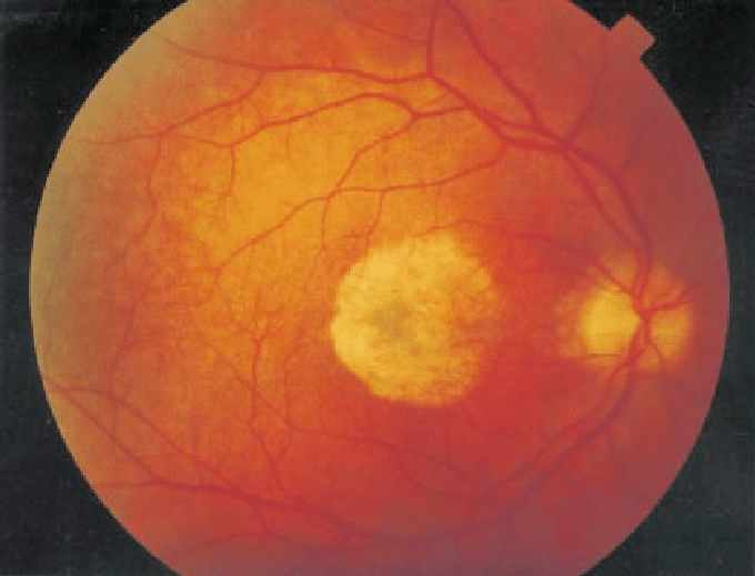 Retinografia: você sabe o que é esse exame?