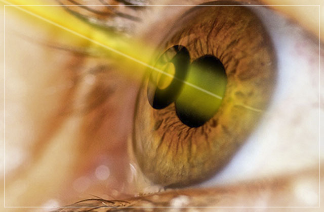 4 Dúvidas comuns sobre o Laser de Retina